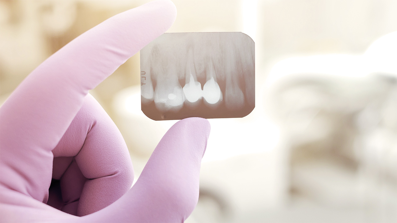 Dental Crowns Dental Crowns
